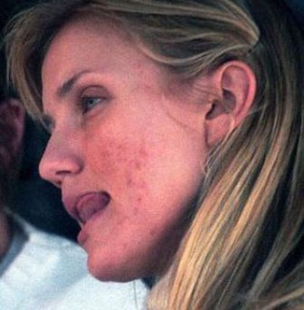 actors with bad acne
