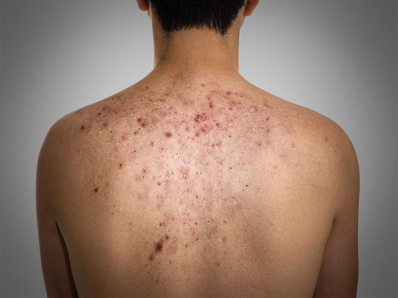 Home Remedies For Pimples On Back