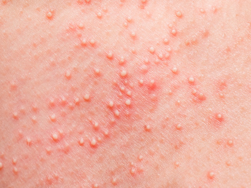 How To Get Rid Of Sweat Pimples