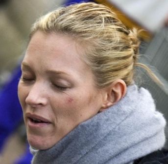celebrities with severe acne