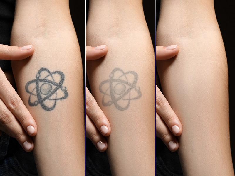 Tattoo Removal