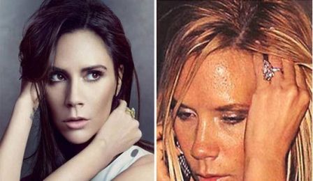What celebrities have acne