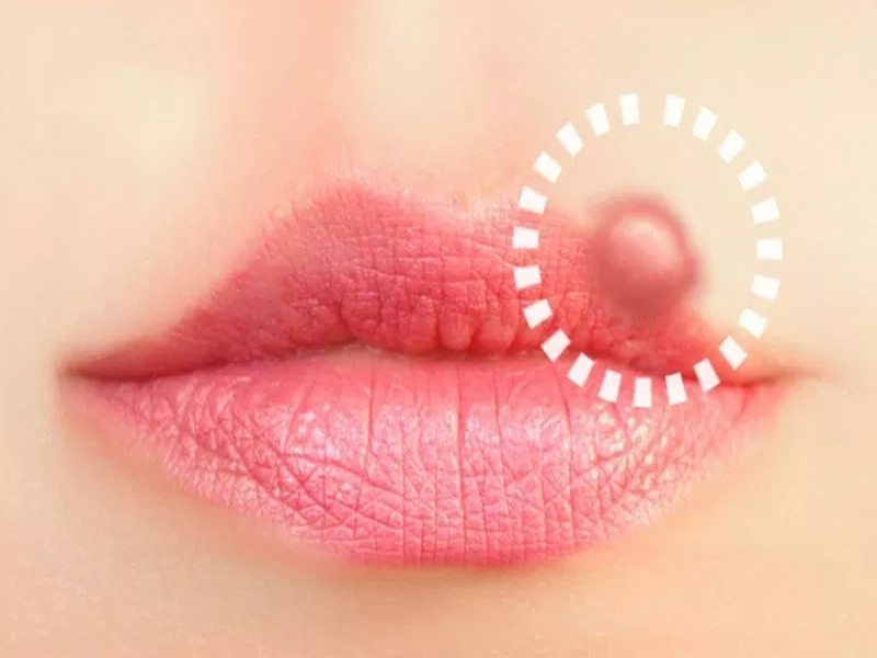 Causes And Symptoms Of Herpes