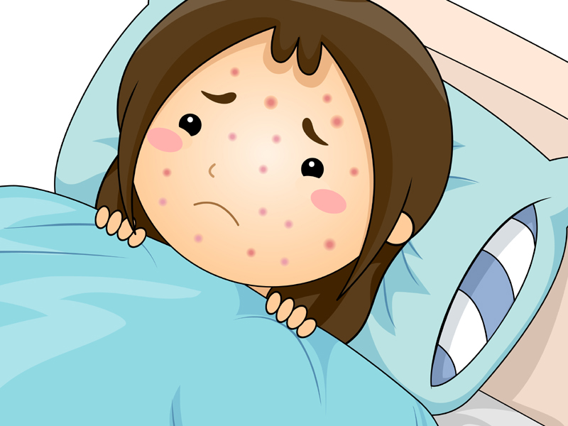 Chickenpox Signs