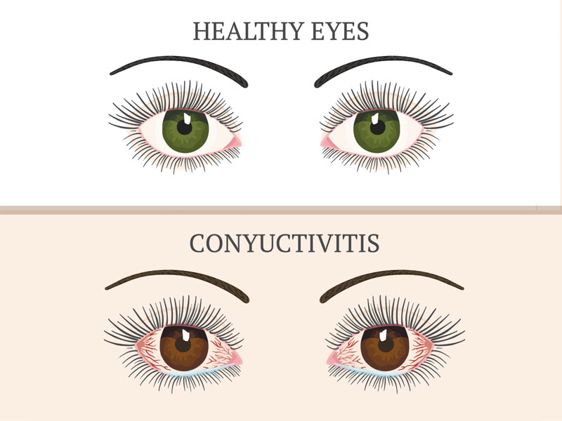 Home Remedies For Pink Eye (conjunctivitis)