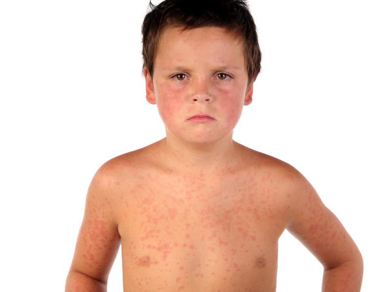 Varicella Symptoms