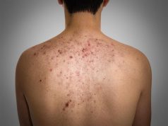 15 Best Home Remedies For Pimples On Back