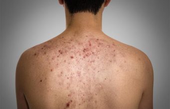 15 Best Home Remedies For Pimples On Back