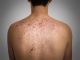 15 Best Home Remedies For Pimples On Back