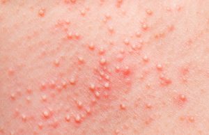 How To Get Rid Of Sweat Pimples?