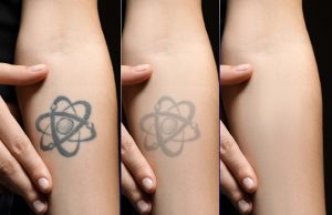 Tattoo Removal 2025: The Complete Guide to Regret-Free Skin!