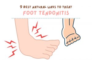 9 Best Natural Ways to Treat Foot Tendonitis at Home