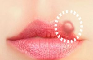 Know the Causes and Early Symptoms of Herpes