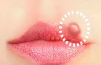 Know the Causes and Early Symptoms of Herpes