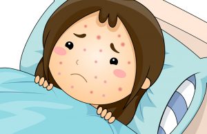 Chickenpox (Varicella): Signs, Symptoms, Causes and Complications.
