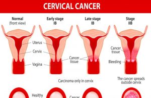 Cervical Cancer Symptoms And Causes