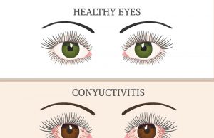 8 Effective Home Remedies to Get Rid of Pink Eye (Conjunctivitis)
